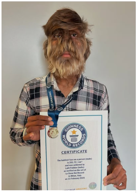 Quem é o indiano que entrou para o ‘Guinness’ por quebrar recorde de rosto mais peludo