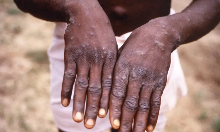 Ministrio da Sade envia equipe para monitorar caso de Mpox em So Paulo